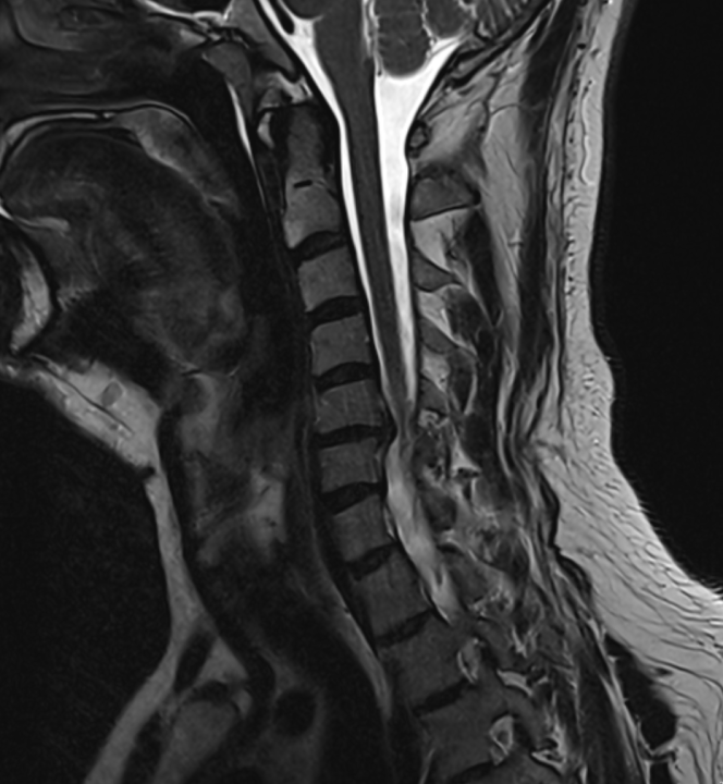 Nakkeprolaps - bilde.PNG